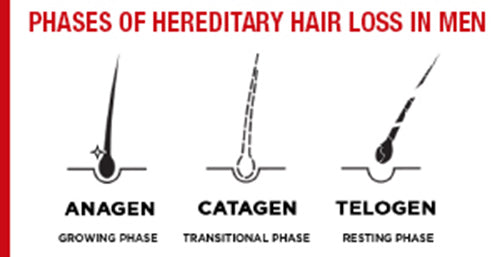 Hereditary hair loss in men